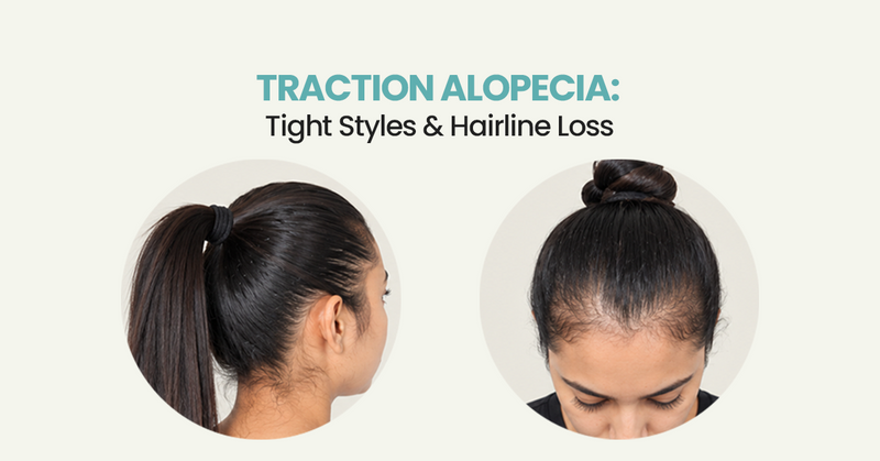 Traction Alopecia: Tight Styles & Hairline Loss