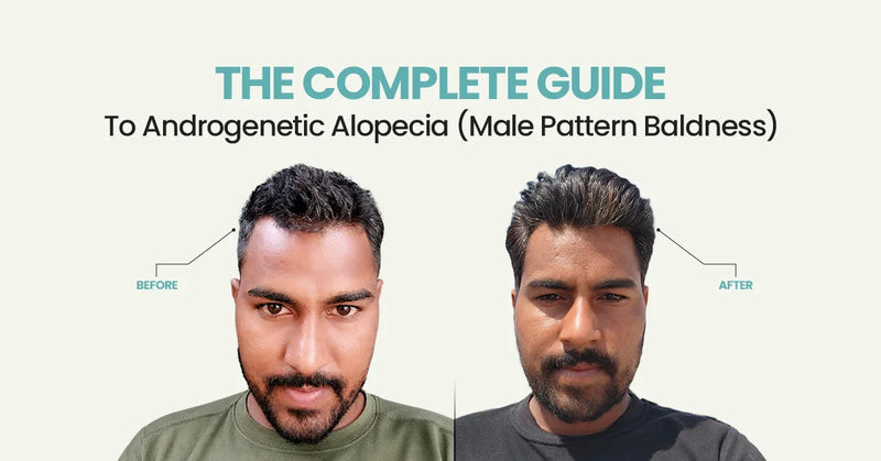The Complete Guide to Androgenetic Alopecia (Male Pattern Baldness)