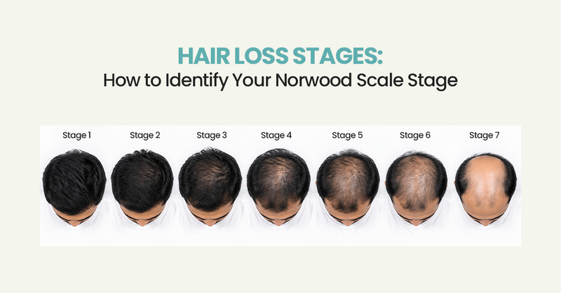Hair Loss Stages: How to Identify Your Norwood Scale Stage