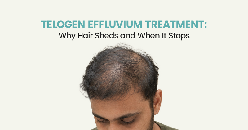 Telogen Effluvium Treatment: Why Hair Sheds and When It Stops