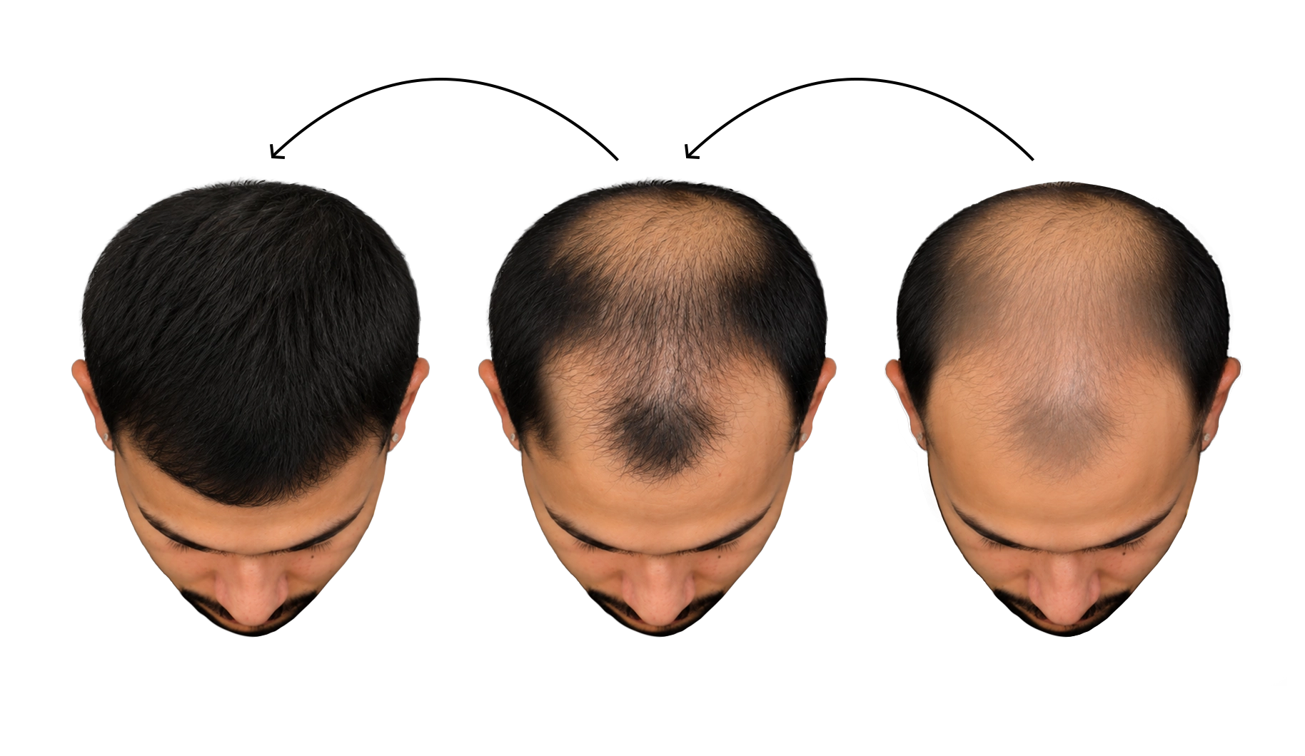 Hair Loss Treatment Plans