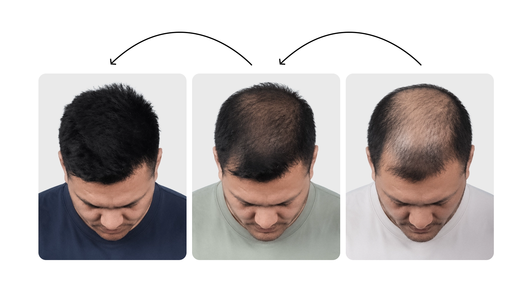 Hair Loss Treatment Plans